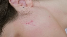 close up of the face of a young woman with problem skin red rashes, acne scars. Painful inflammation, adolescence, poor nutrition, hormonal imbalance, sensitive skin before treatment - Powered by Shutterstock - Get 15% off with code: PIKWIZARD15
