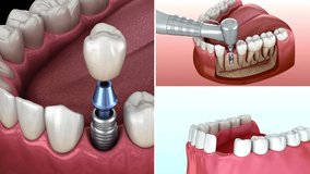 Dental care. Dental Implant. Dental root anatomy. Videos of human teeth and dentures concept. Dental clinic procedures.