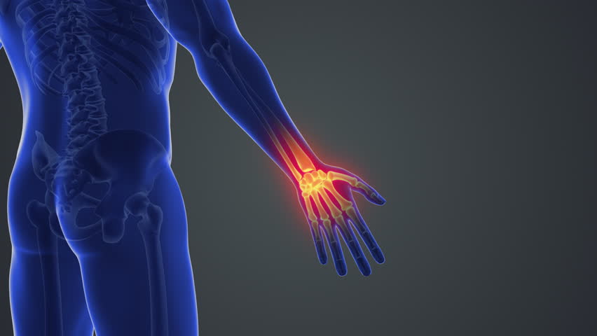 Medical animation with wrist joint pain