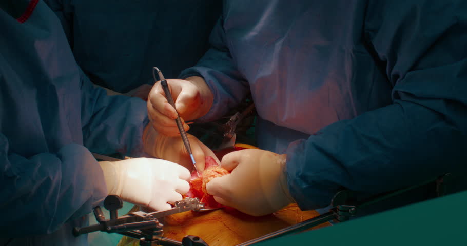Closeup of cancer malignant tumour removal surgery from stomach area. Surgeons in scrubs and masks perform complicated surgery in operating theatre | Shutterstock HD Video #1111586745