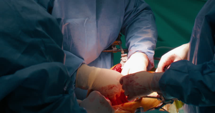 Close up of cancer surgery. Team of skilled surgeons remove cancer cells from stomach with modern laser technology,cut out tumor from patient body,working on open wound.Handheld documentary style shot | Shutterstock HD Video #1111589487