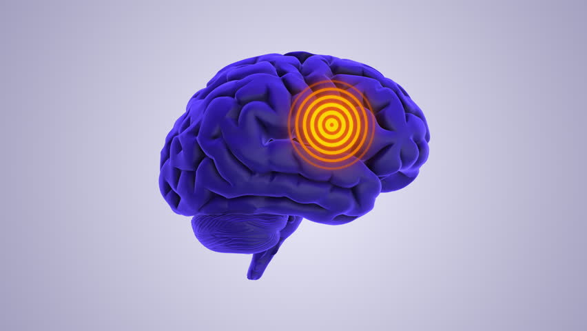 Brain chronic pain medical animation