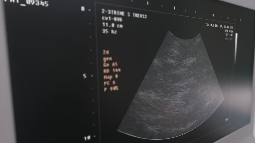 Scanner demonstrates two babies in the womans belly. Prenatal inspection scanner detects twin babies in the belly. Prenatal inspection scanner checks the health of babies in the belly. Hospital. | Shutterstock HD Video #1111804521