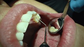Dental Care Extreme Close up Macro Video. Dentist treat patient teeth. Orthodontist works with microscope and dental mirror. Concept of professional dental hygiene. 4k 120 fps slow motion raw footage