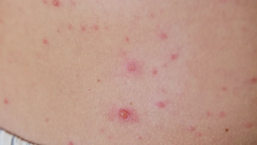 The classic symptom of chickenpox is a rash that turns into itchy, fluid-filled blisters. | Shutterstock HD Video #1111833865