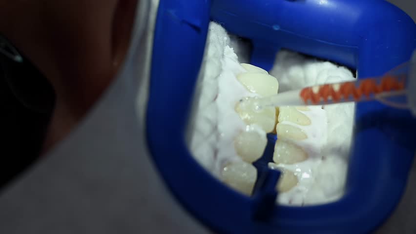 Dental Whitening process in patient mouth. Teeth whitening with UF Lamp, Led Lamp and gel. Dental Extreme Close up Macro Video. Concept of professional dental hygiene. 4k 120 fps slow motion footage | Shutterstock HD Video #1111860069