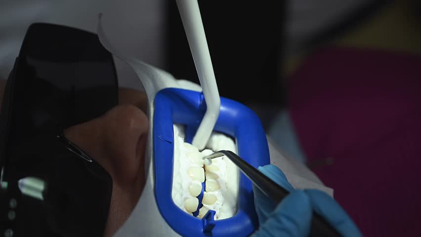 Dental Whitening process in patient mouth. Teeth whitening with UF Lamp, Led Lamp and gel. Dental Extreme Close up Macro Video. Concept of professional dental hygiene. 4k 120 fps slow motion footage | Shutterstock HD Video #1111860107