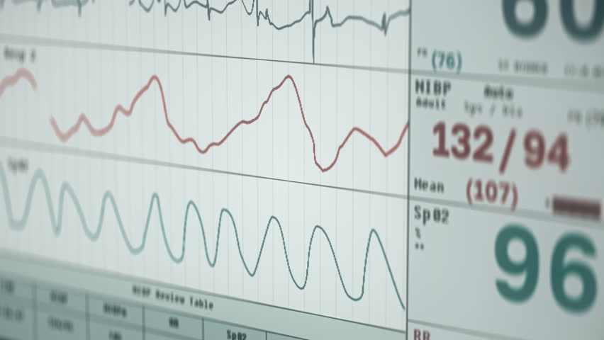Signalling for emergency after the detection of falling heart rate. Heart rate of the emergency patient quickly slowing down. Recording the death of the sick person after the stoppage of heart rate. | Shutterstock HD Video #1111940533