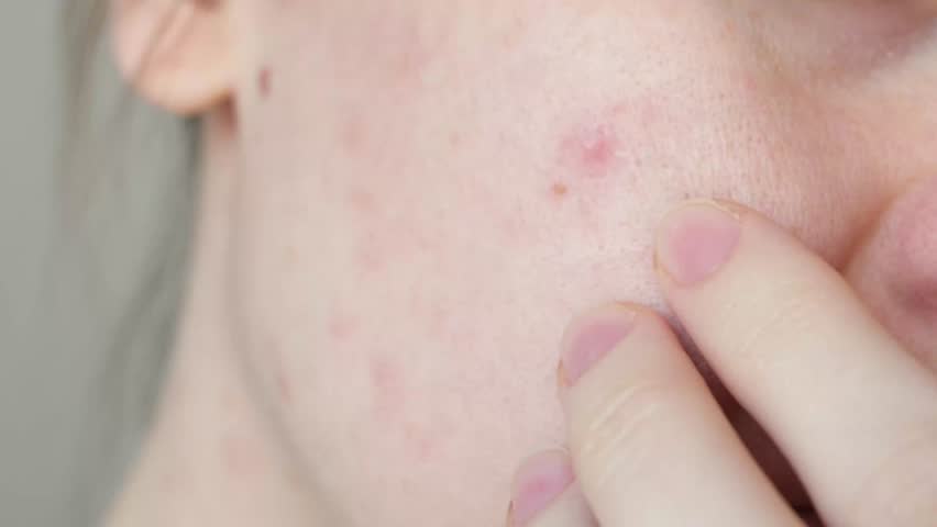 Close up skin with acne, peeling and enlarged pores. Dry skin with inflammation. Woman touching acne on her face. Skin problems, allergic, redness. Healing pimples. Pimple squeezing. 4K Video