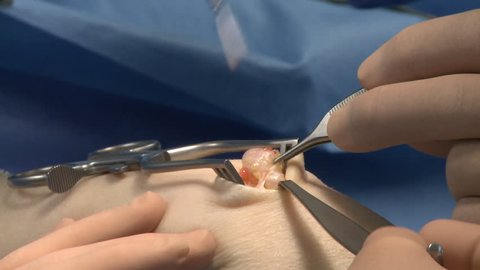 surgery in an operating room/update of a cyst in the wrist
