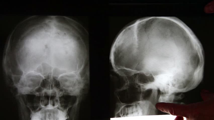 Сотрясение черепа. Сотрясение головного мозга рентген. Снимок головы сотрясение. Рентген черепа сотрясение мозга.