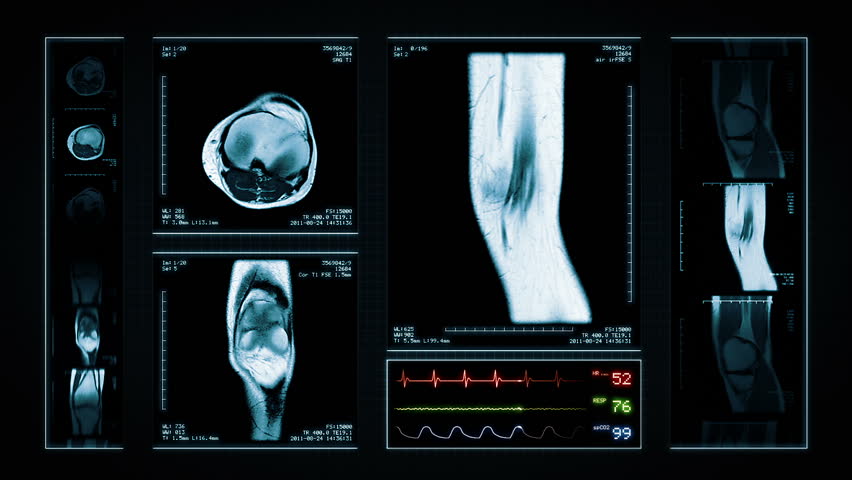 Knee MRI Scan. Blue. 4 videos in 1 file. Animation showing top, front, lateral view and ECG display. Each video is loopable. Medical Background. More options in my portfolio. Royalty-Free Stock Footage #11748185