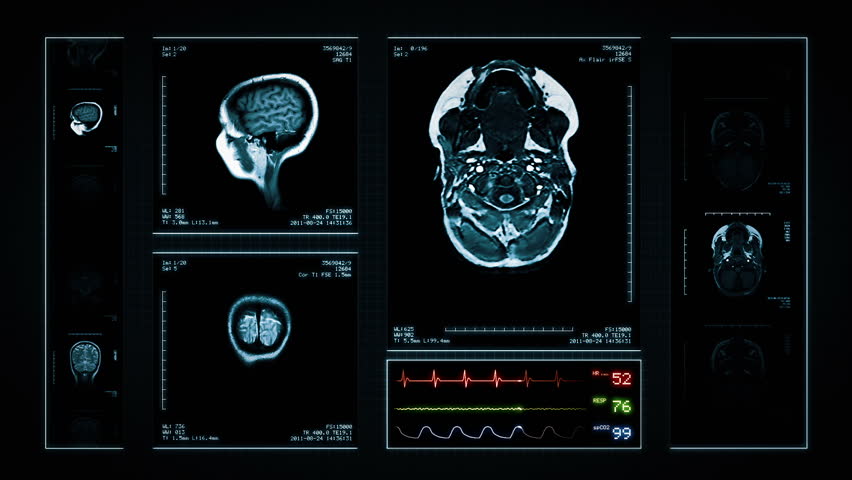 Brain MRI Scan. Blue. 3 videos in 1 file. Animation showing top, front, lateral view and ECG display. Each video is loopable. Medical Background. More options in my portfolio. Royalty-Free Stock Footage #11748410