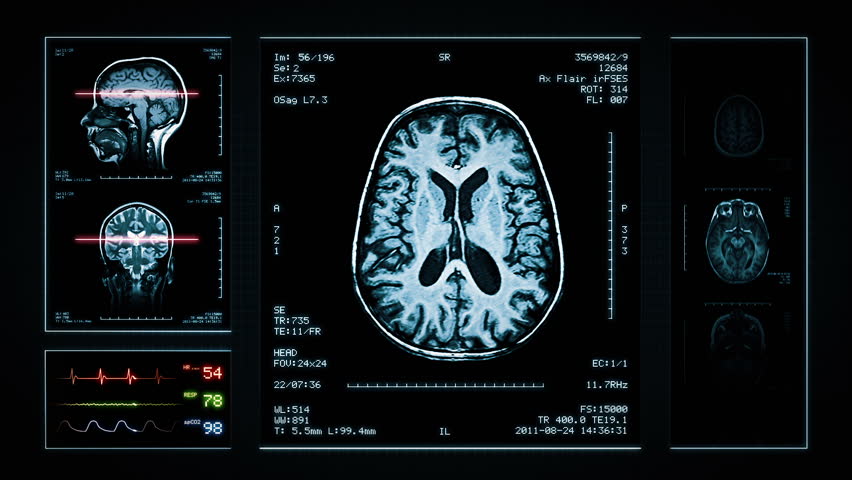 Brain MRI Scan. Blue. 3 videos in 1 file. Animation showing top, front, lateral view and ECG display. Each video is loopable. Medical Background. More options in my portfolio. Royalty-Free Stock Footage #11748410