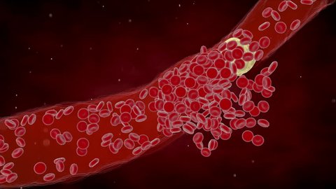 Clogged Artery  cholesterol plaque, 4k medical concept 3d animation. Red blood cell