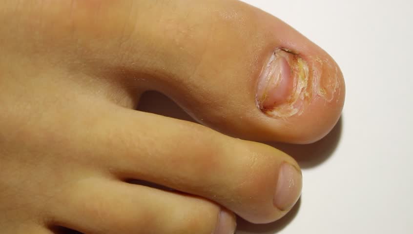 A New Nail Grow Back Stock Footage Video 100 Royalty Free 12634193 Shutterstock