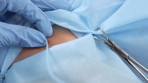 Angiographic Catheter Uterine fibroid embolization procedure.
