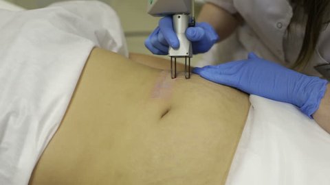 The doctor removes the stretch marks on the abdomen of the patient by means of a laser