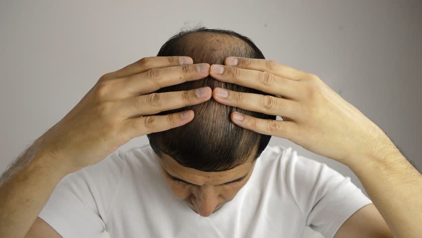 Close up of man controls hair loss | Shutterstock HD Video #13374221