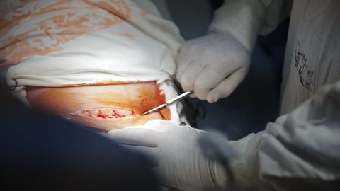 Caesarean section, surgeon cutting stomach with scalpel