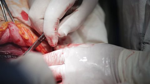 Caesarean section, surgeon cutting stomach with scalpel