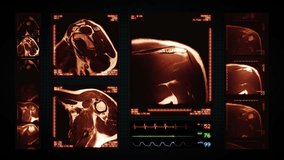 Shoulder MRI Scan. Amber. 4 videos in 1 file. Animation showing top, front, lateral view and ECG display. Each video is loopable. Medical Background.
