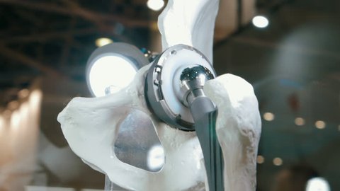 The internal structure of an artificial hip joint human. Titanium ball enters to the plastic saddle joint