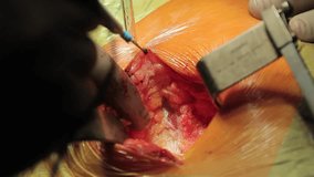 Slicing through flesh

Surgeon slicing the flesh to get to the muscle with electrosurgical scalpel (CU)