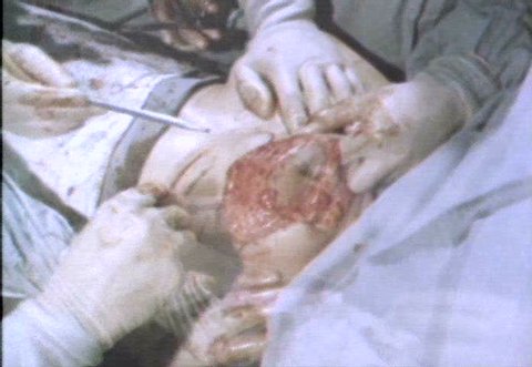 CIRCA 1950s - A low angle of a surgeon cutting down to the pectoral fascia to create a new nipple site during a mammoplasty procedure in the 1950s.