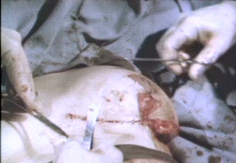 CIRCA 1950s - A surgeon finishes suturing the first breast, breasts are compared, and surgery begins on the second breast during a mammoplasty procedure in the 1950s.