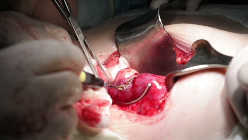 Surgery for cancer excision