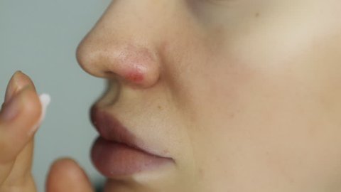 Herpes on the nose - Pretty young caucasian woman with herpes her on nose, close-up. Human Virus. Using an ointment for herpes