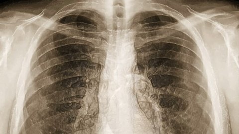 X-ray of chest covered with transparent skin. (loop ready file)