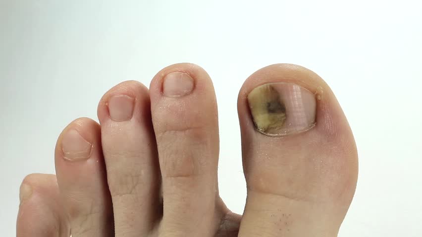 Toenails With Fungal Infection Sick Stock Footage Video 100 Royalty Free Shutterstock