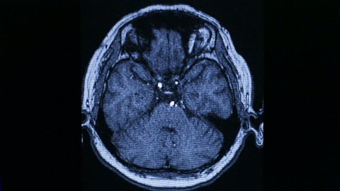 MRI brain scan on black background
