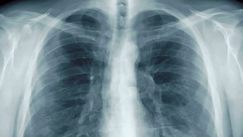 Chest x-ray with transparent lungs.  (loop ready animation)
