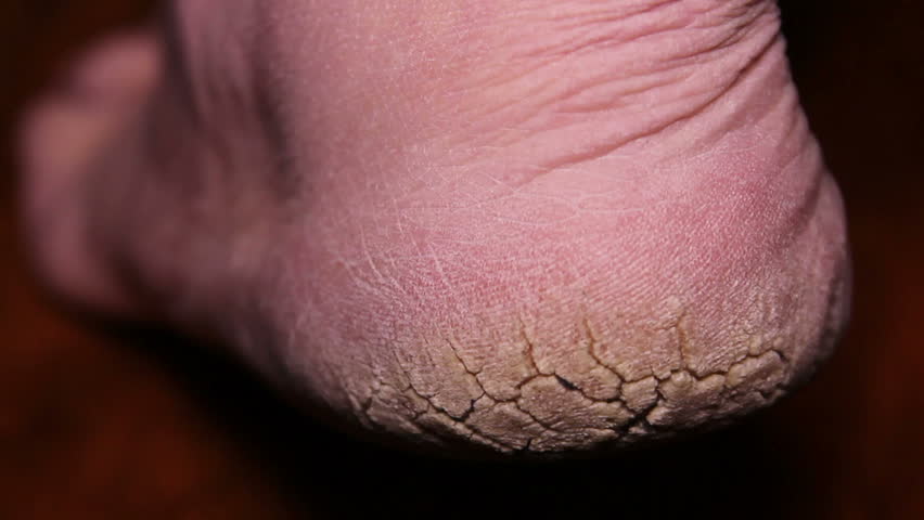 Extremely Dry Cracked Heels Stock 