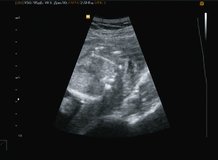 Ultrasonography of heartbeat of the small baby. Video full hd.