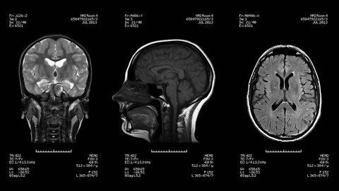 Three head views of MRI scan. Loopable. Black and White. Medical exam. See more color options in my portfolio.