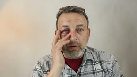 Man with Black Eye, Shiner. Man's face after the fight and assault. Middle-aged Caucasian male Emotional Portrait with a Real Bruise after the fight. Bully and Teaser. HiddenViolence. 
