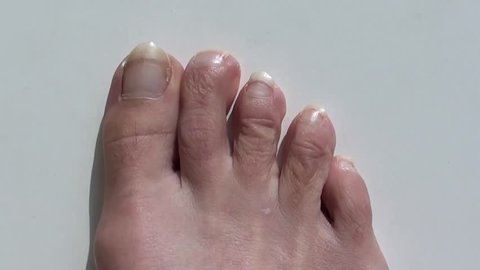 Webbed Toes Syndactyly Affecting Feet Fusion Stock Photo 1481908319 ...