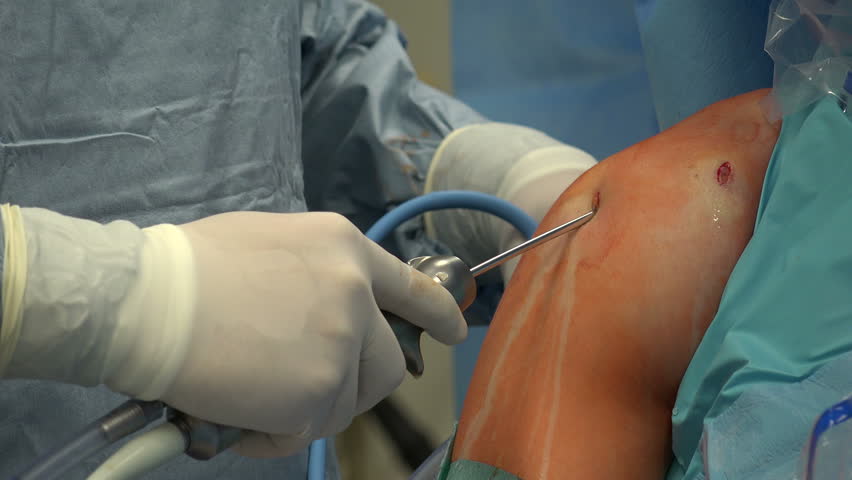 Arthroscopic Shoulder Surgery the Shoulder Stock Footage Video (100%  Royalty-free) 16180357 | Shutterstock