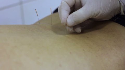 Acupuncture Doctor Establishes Needle In Back