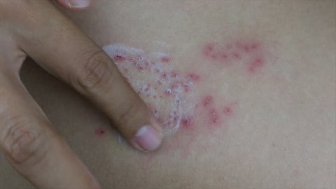 Raised red bumps and blisters on skin with white cream selective focus on finger
