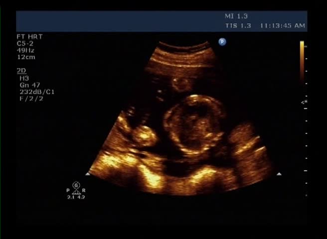 Medical ultrasound scan of human embryo - heartbeat