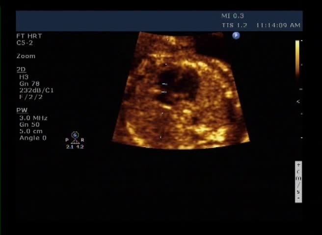 Medical ultrasound scan of human embryo - heartbeat