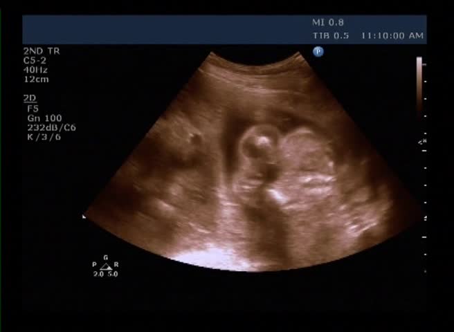 Medical ultrasound scan of human embryo - measurements of the size of the head