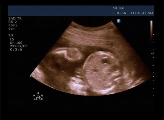 baby ultrasound scan - measurements of the size and determination of sex