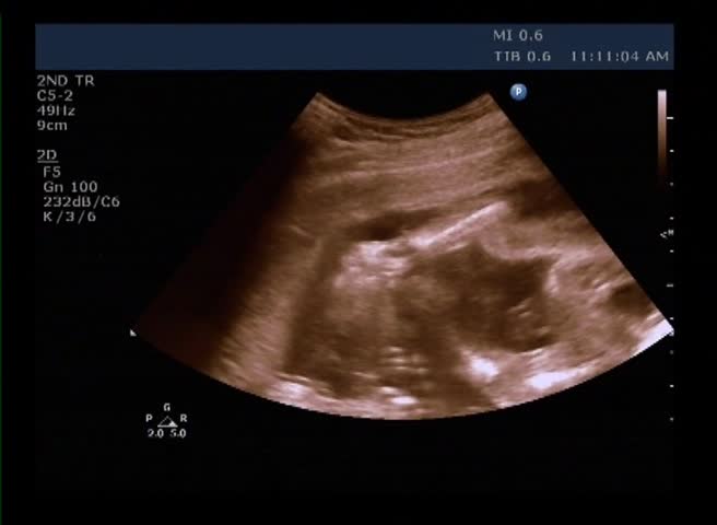 baby ultrasound scan - child yawns