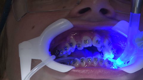 lv light for braces